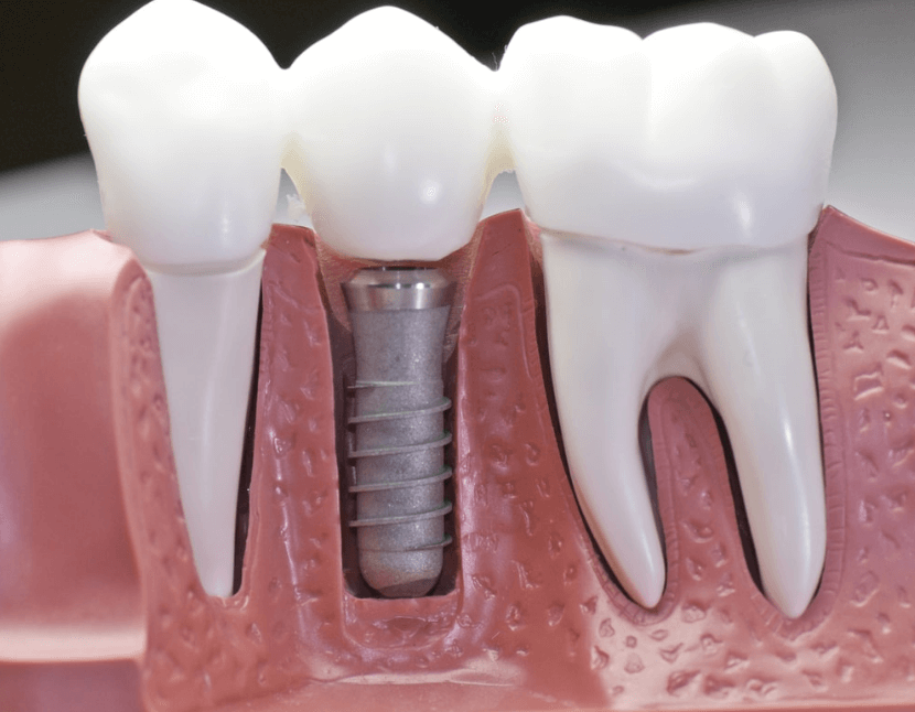 are dental implants covered by insurance