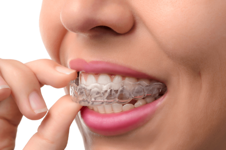Learn All About How Much Is Invisalign Without Insurance?